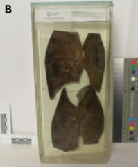 ホルマリン漬けにされた犠牲者の肺