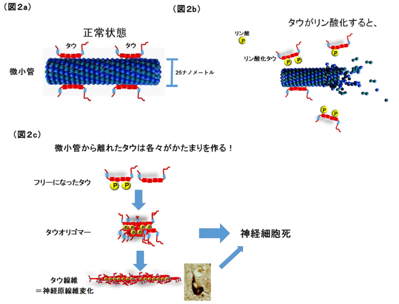 リン酸化したタウタンパク質はアルツハイマー病の原因になり得ます