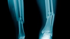 骨折したら「生分解性人工骨」をその場でプリントできる新技術が開発の画像 2/3