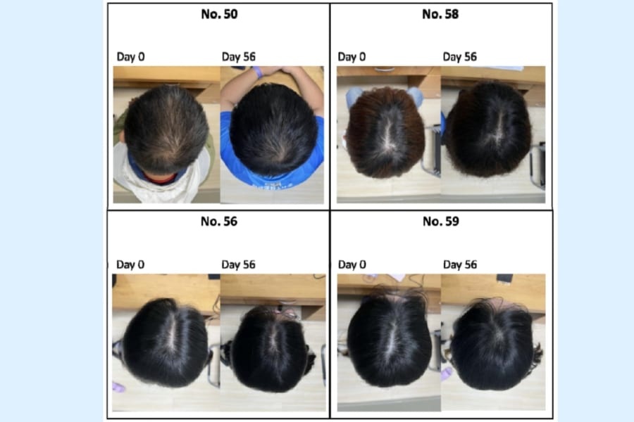 【京大】8週間で髪を「太く・多く・長く」する植物エキスを開発