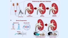 尿管結石を包んでまとめて除去してくれる「逆服薬ゼリー的手法」が誕生の画像 2/4