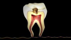 歯のエナメル質を修復するジェルが誕生――虫歯治療に革命か？の画像 4/4