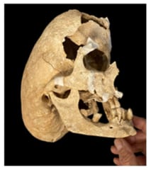 重度の奇形をもつ「中世騎士の頭蓋骨」を発見の画像 2/2