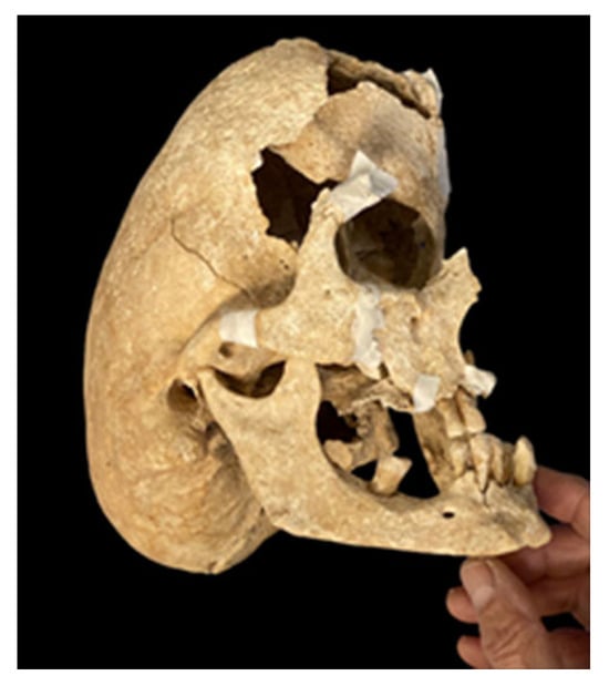 重度の奇形をもつ「中世騎士の頭蓋骨」を発見の画像 2/2