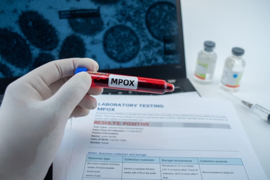 新たに進化した「エムポックス変異株」を確認、英国保健当局が報告