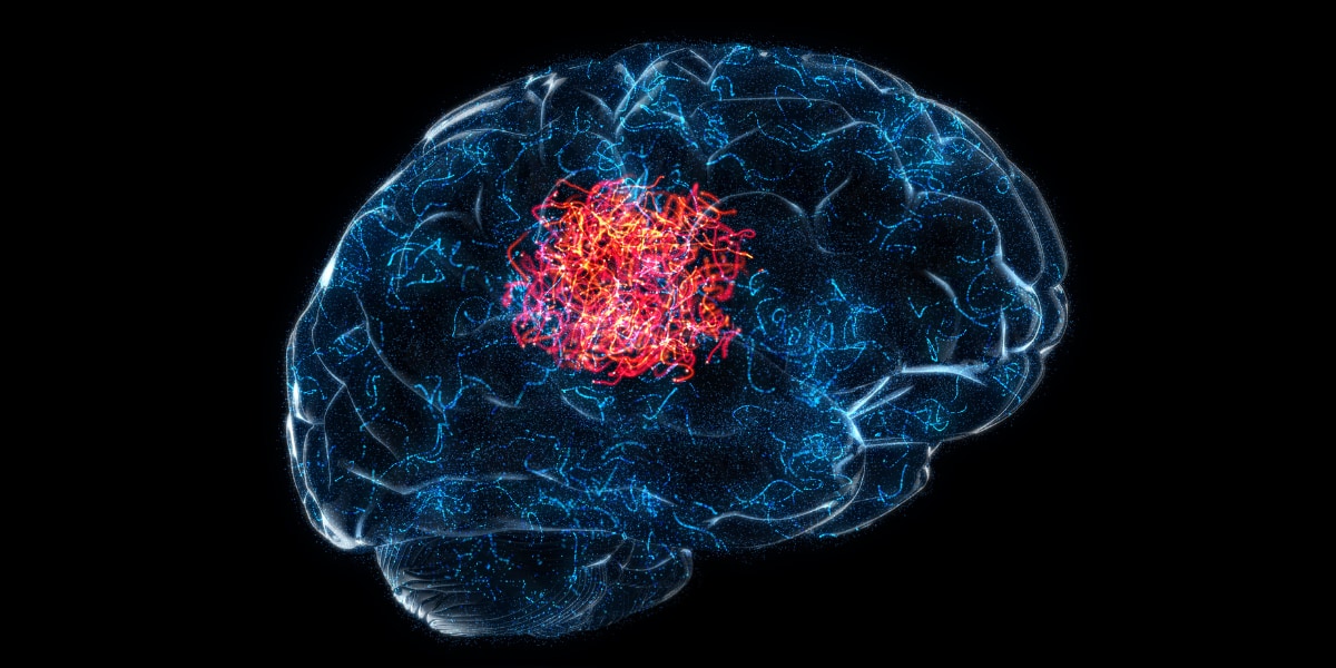 がん細胞の出す物質が脳をアルツハイマー病から守っていた