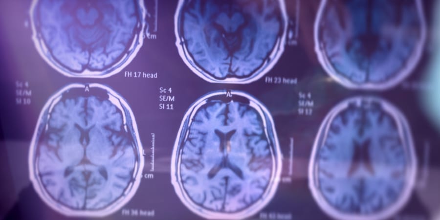 がん患者はアルツハイマー病になりにくいという長年の謎