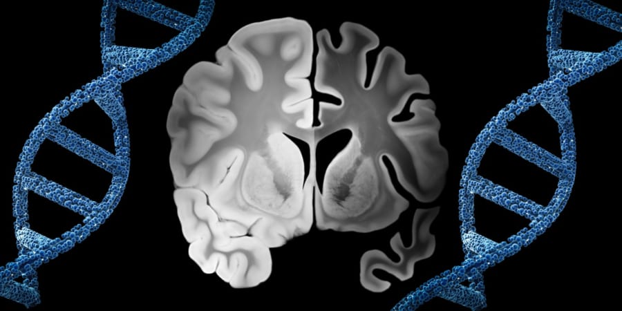 肉の摂取量が多いとアルツハイマー病のリスク遺伝子の不利を跳ね返せる