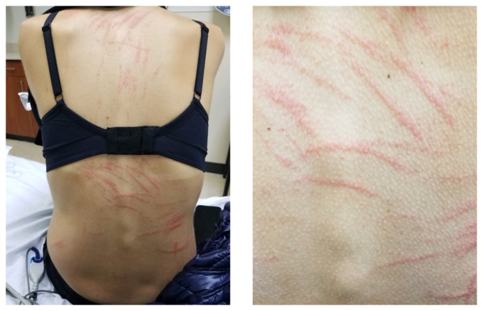 シイタケを食べた女性、背中に「鞭で打たれたような跡」が浮かび上がる症例の画像 2/2