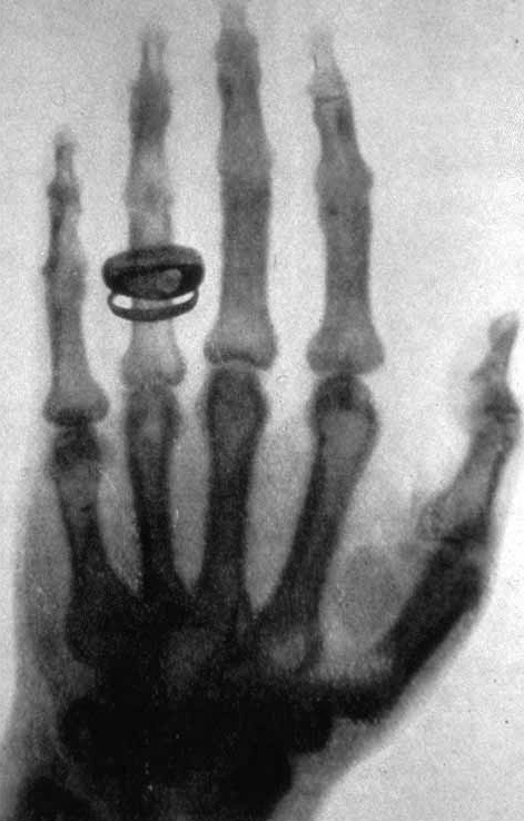 世界初の「X線被曝による犠牲者」はエジソンの助手だったの画像 2/3