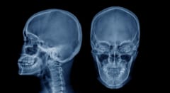 頭蓋骨の中に新たな「器官」を発見――そこは最前線で脳を守る免疫拠点だったの画像 1/4