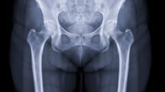 たった1度の点滴で骨折は94％減少、骨強度も増加
