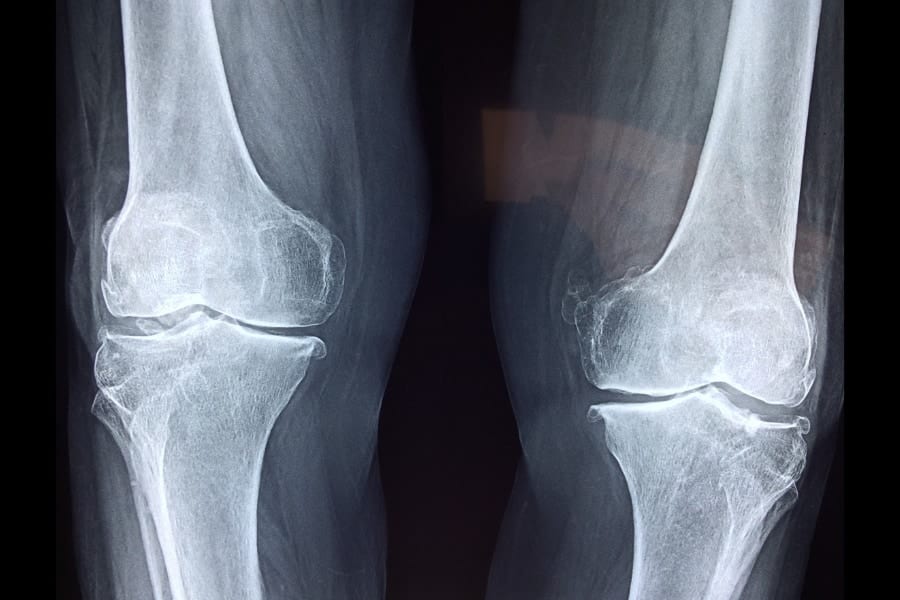 「生きた薬」を1回点滴しただけで骨粗鬆症患者の骨折が94%減――スカスカの内側が埋まり始めていた