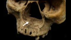 古代中国の鼻削ぎ刑の初めての人骨証拠か——鼻切断をめぐる特異な考古学的事例