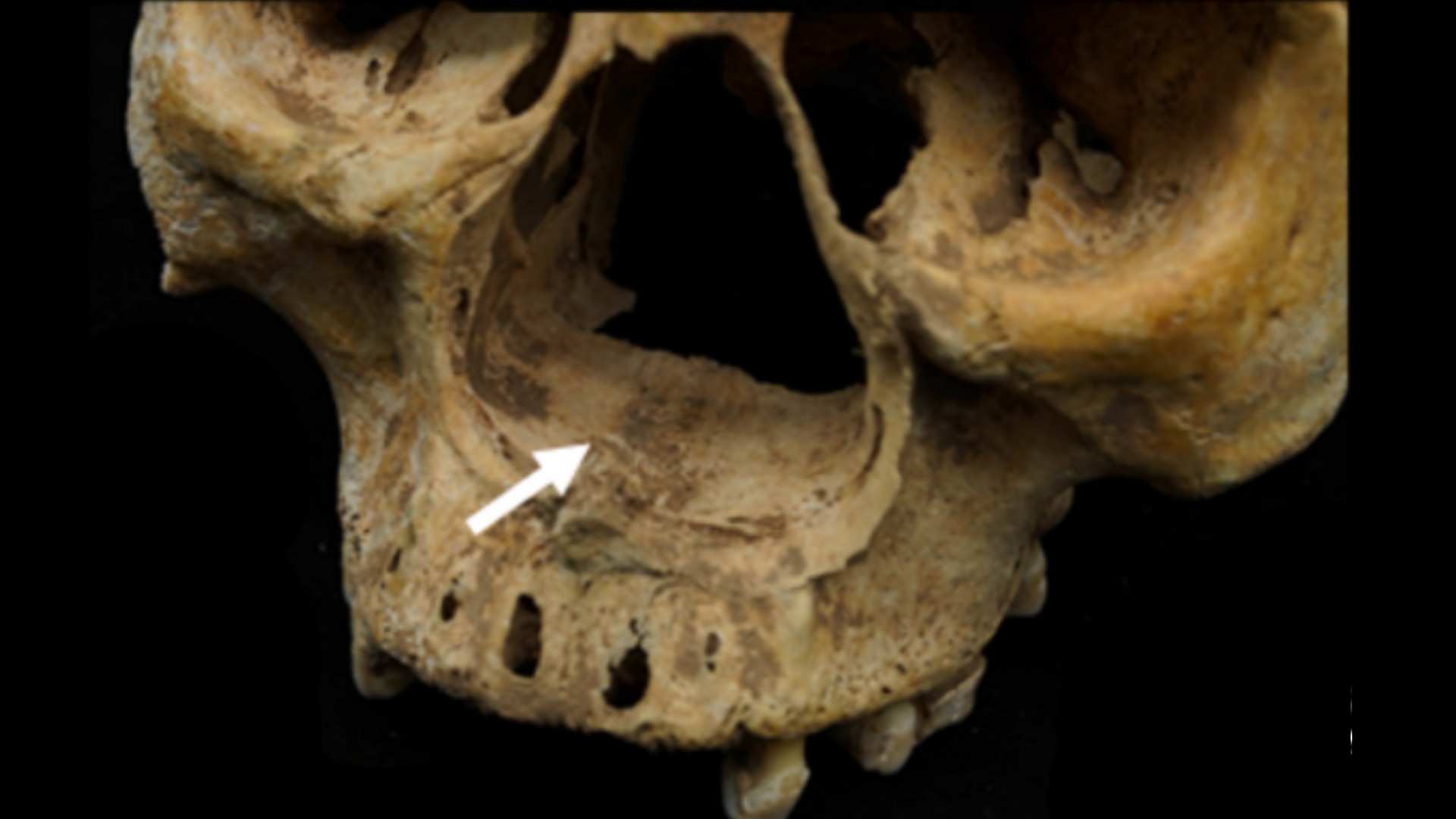 古代中国の鼻削ぎ刑の初めての人骨証拠か——鼻切断をめぐる特異な考古学的事例