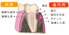 アルツハイマー型認知症の対策には「歯周病予防」が有効と明らかにの画像 3/4