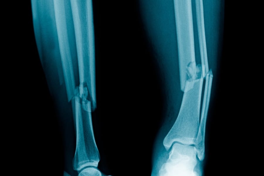骨折したら「生分解性人工骨」をその場でプリントできる新技術が開発