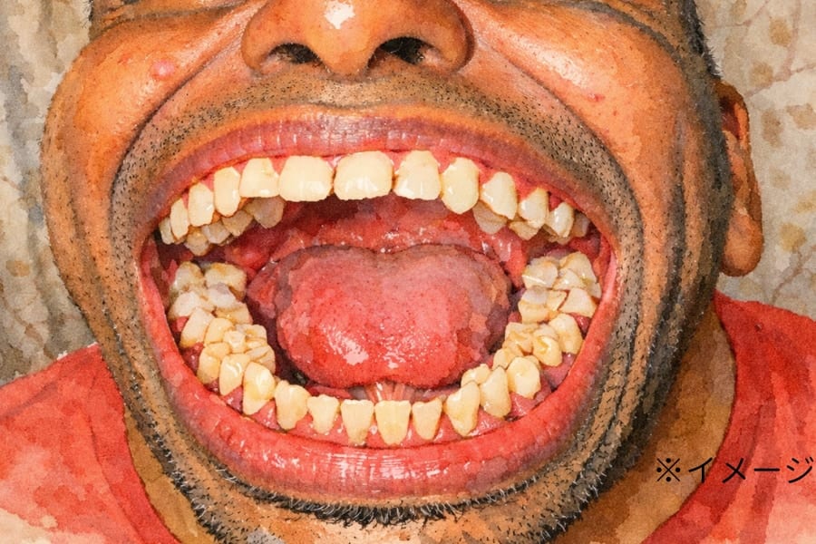 世界一「歯が多い」男性、30代でそのことに気づく【ギネス記録・映像あり】